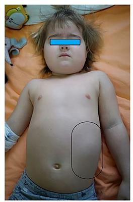 Case Report: Adrenocortical carcinoma in children—symptoms, diagnosis, and treatment